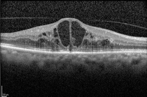 Edema macular quístico