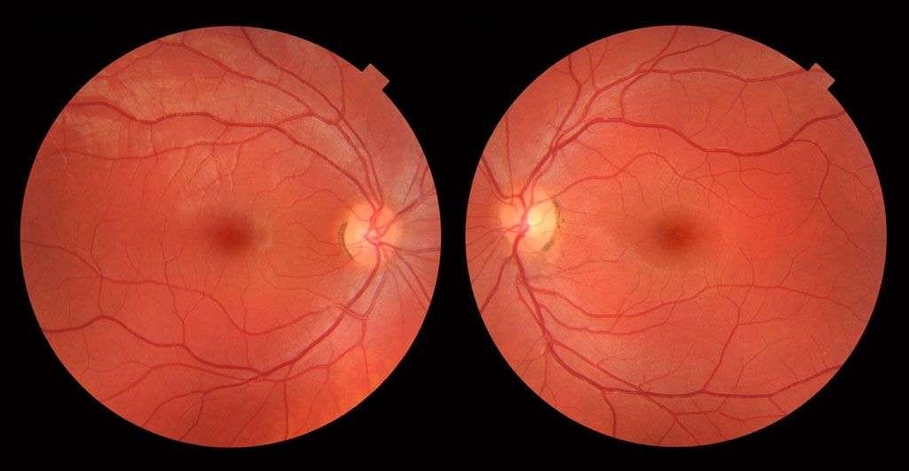 Imagen de Retinografía