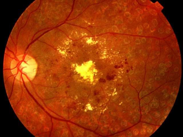 Retinopatía